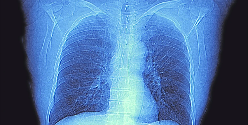 Computed tomography (CT) scan of the chest of an healthy adult, showing normal lungs